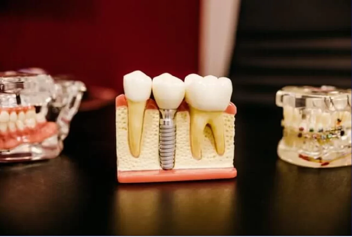 Ce avantaje îți asigură un implant dentar pe termen lung?